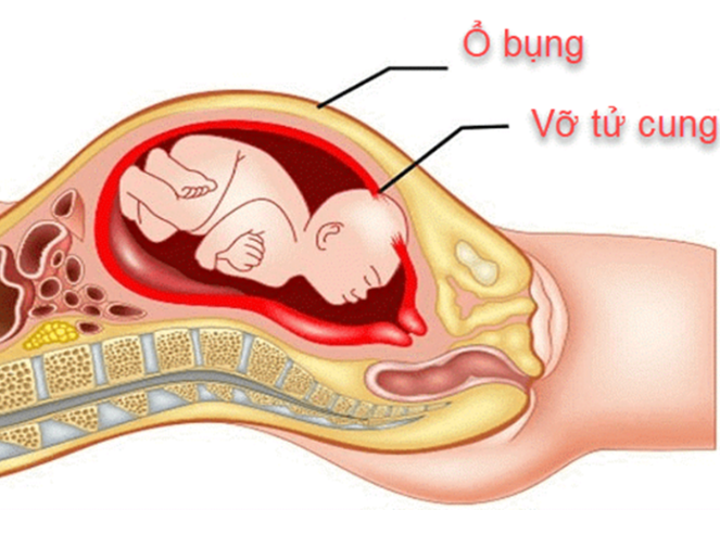 Vỡ tử cung là gì?