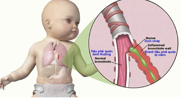 trẻ thở khò khè phải làm sao?